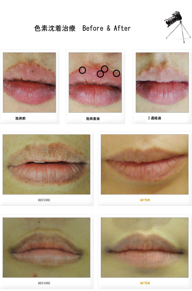 唇の色素沈着 ピンク色の唇 美人をプロデュース 韓国美容整形とダイエット